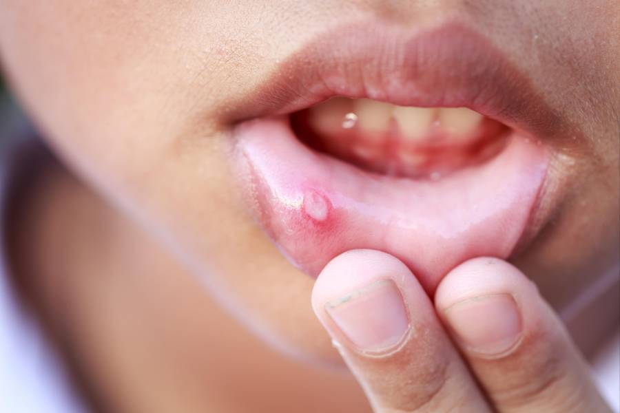 Five tips to get rid of mouth ulcer problem.