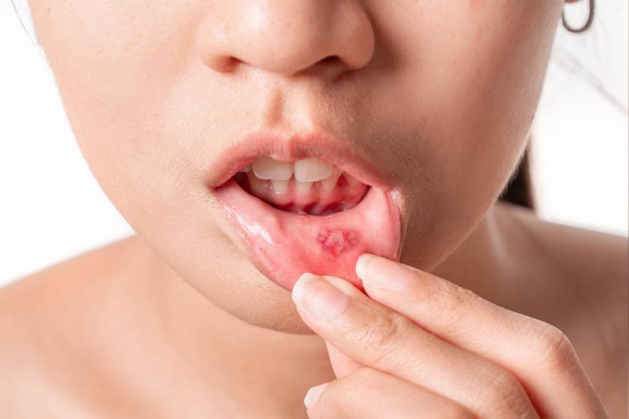 Image of Mouth Ulcer