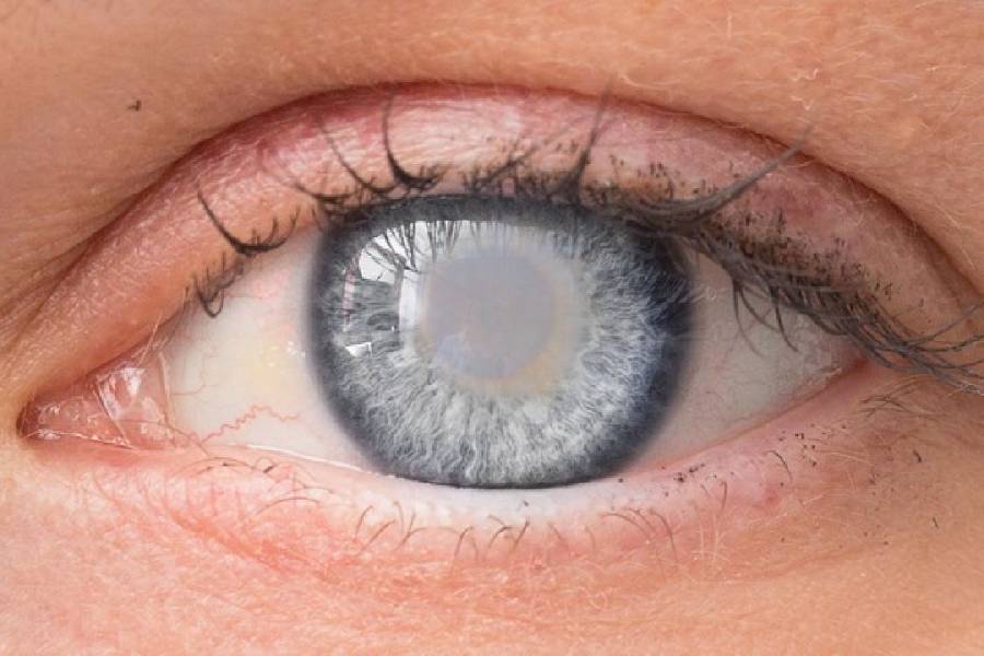 An image of Eye