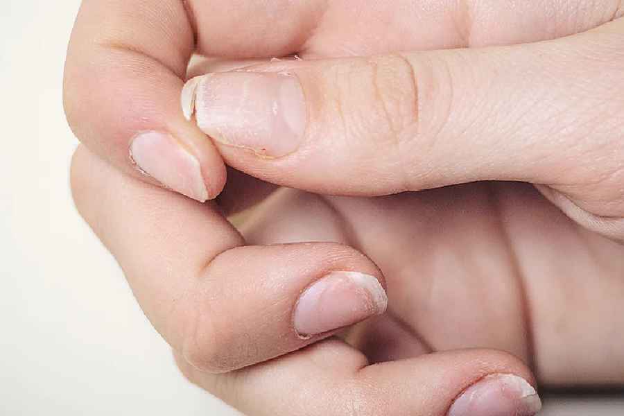 Five warning signs you might have a calcium deficiency.