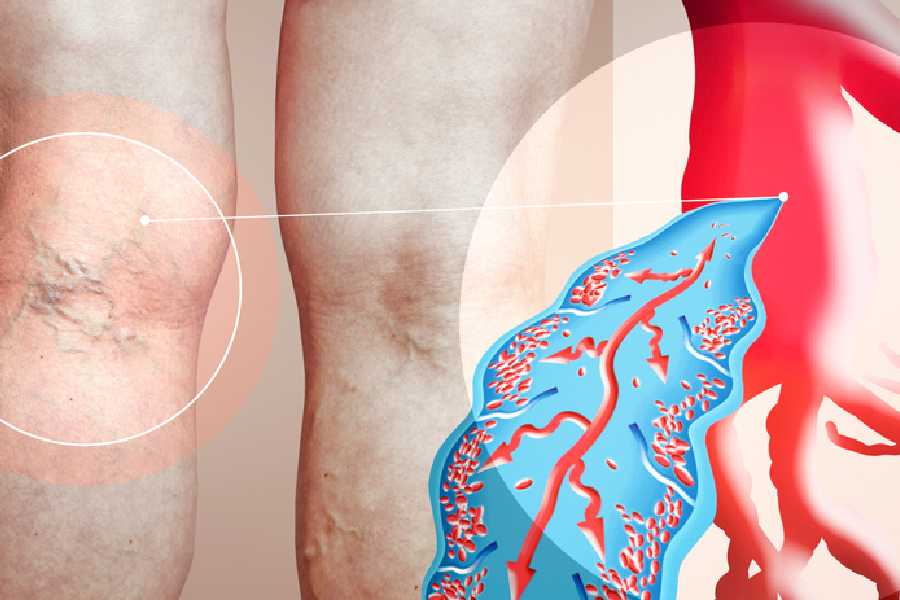 Reasons behind Deep vein thrombosis and how can it turn deadly.
