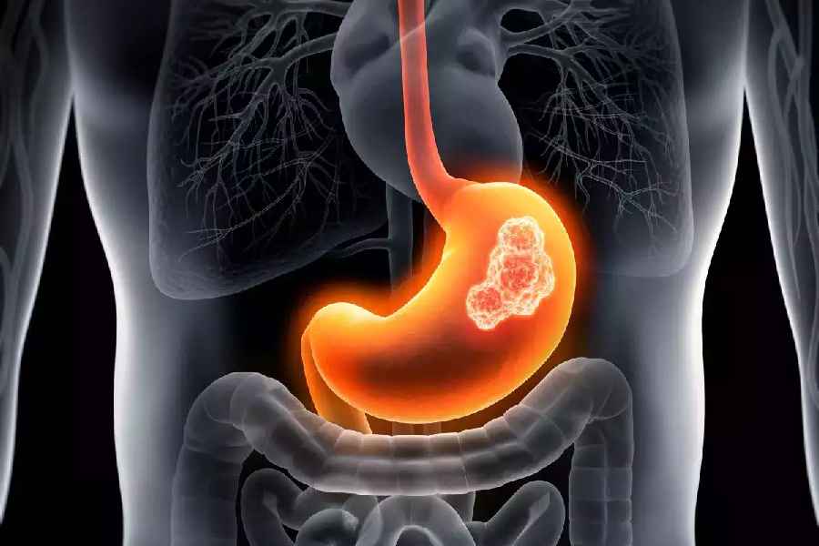 Is Excessive Salt the Cause For Stomach Cancer.