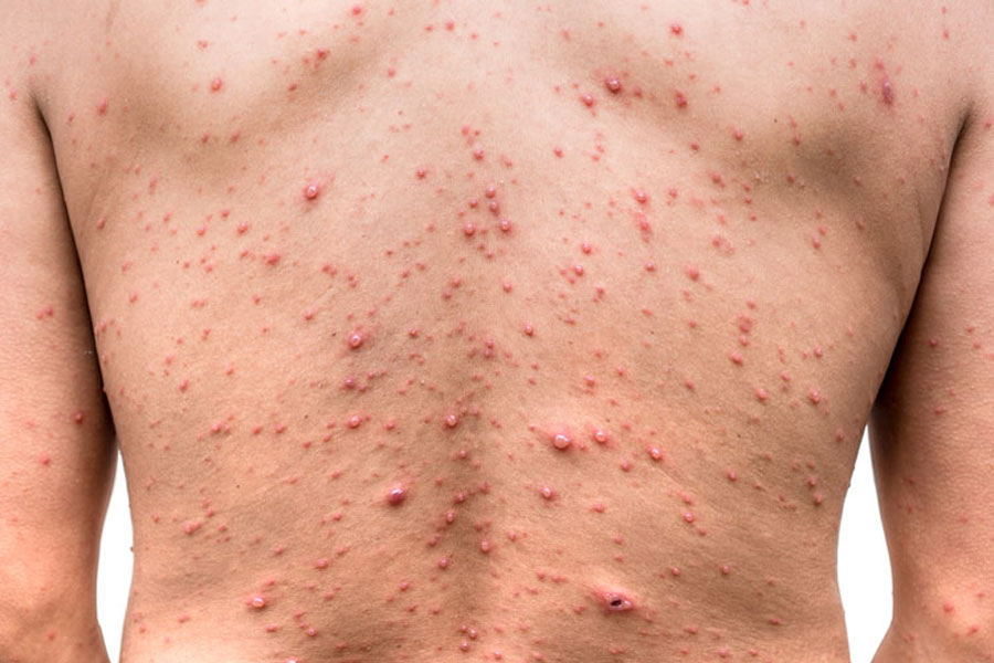 A Photograph of Chicken Pox
