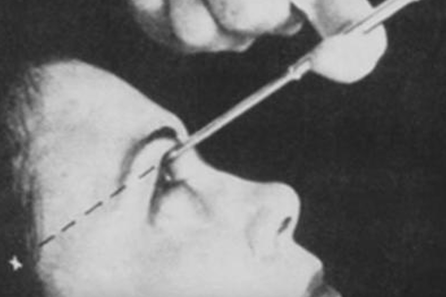 Lobotomy surgery was performed to treat mental illness.