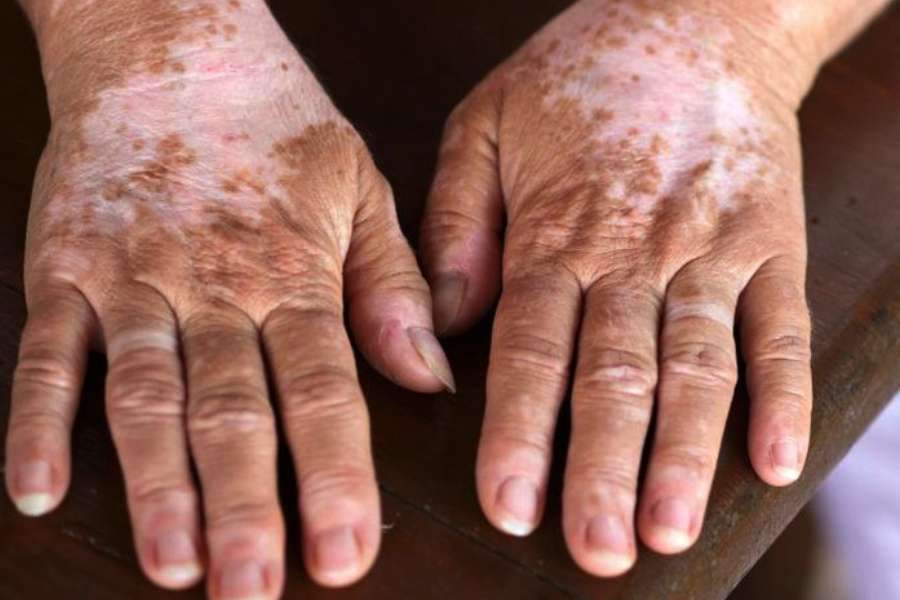Imag of vitiligo 