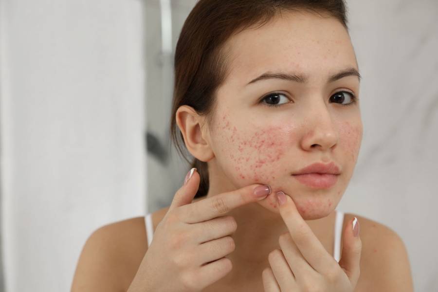 Image of Acne Problem.