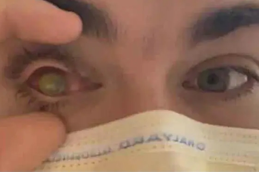 A photograph of a  young man who has lost his vision after flesh eating parasites eat his right eye due to contact lens