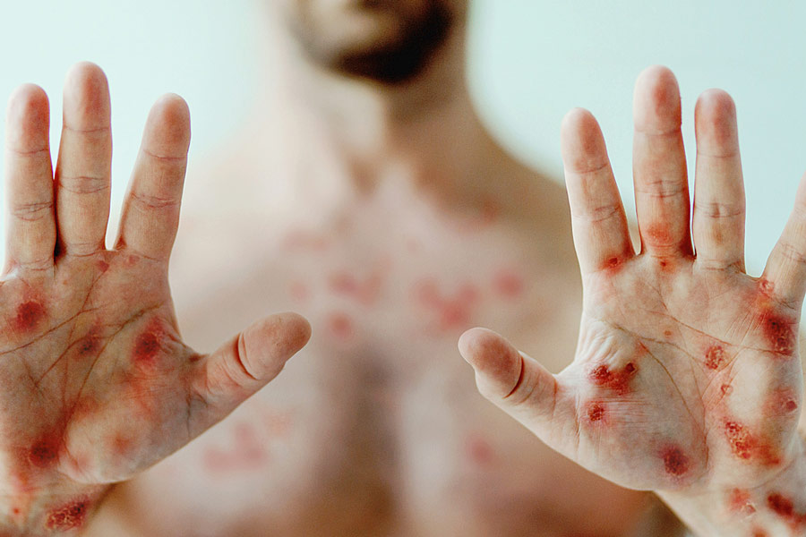 A Photograph representing a person who has affected by Chicken Pox