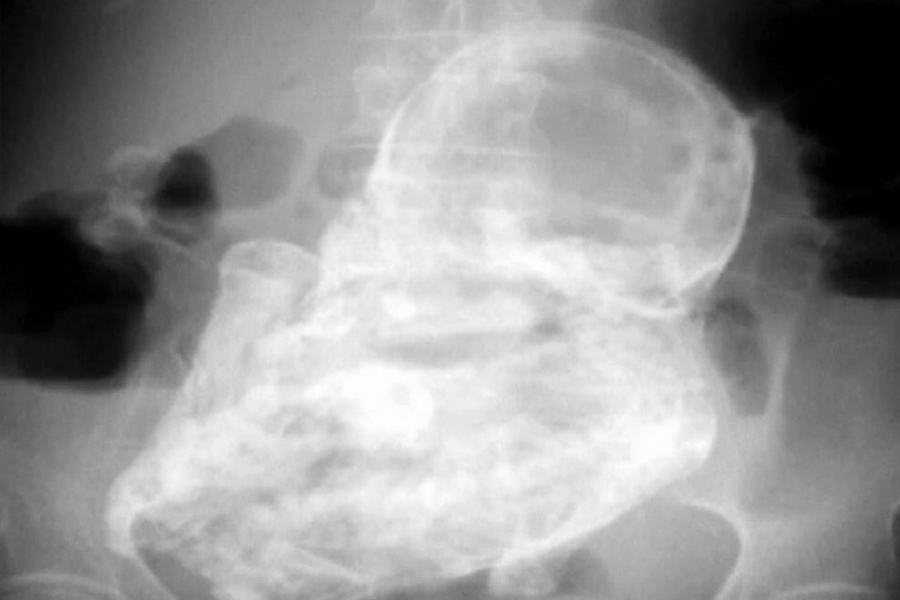 Representational picture of X-ray