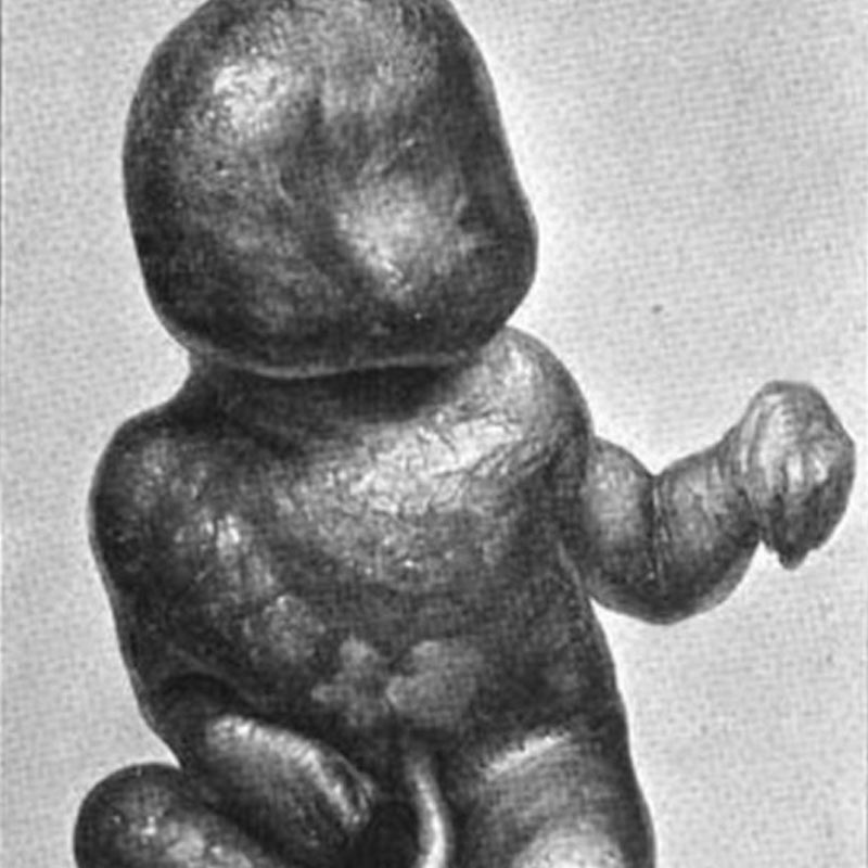 Representational picture dead fetus