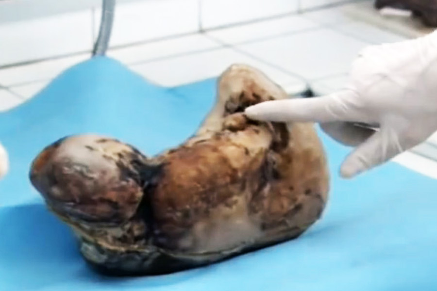 Picture of dead fetus