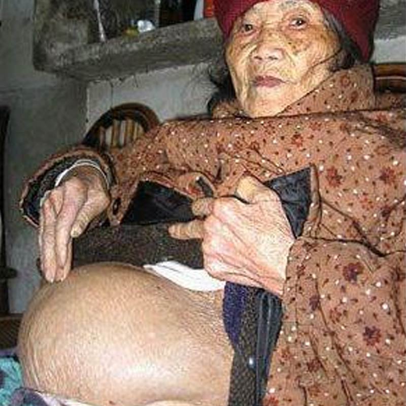 Picture of wlderly woman who carried 'Stone Baby' 