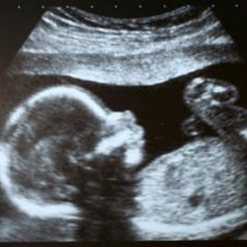Picture of fetus