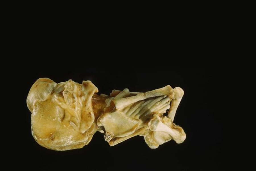 Representational picture of dead fetus