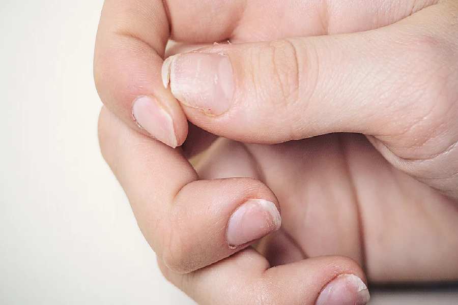 Image of Calcium Defeciency Problem.