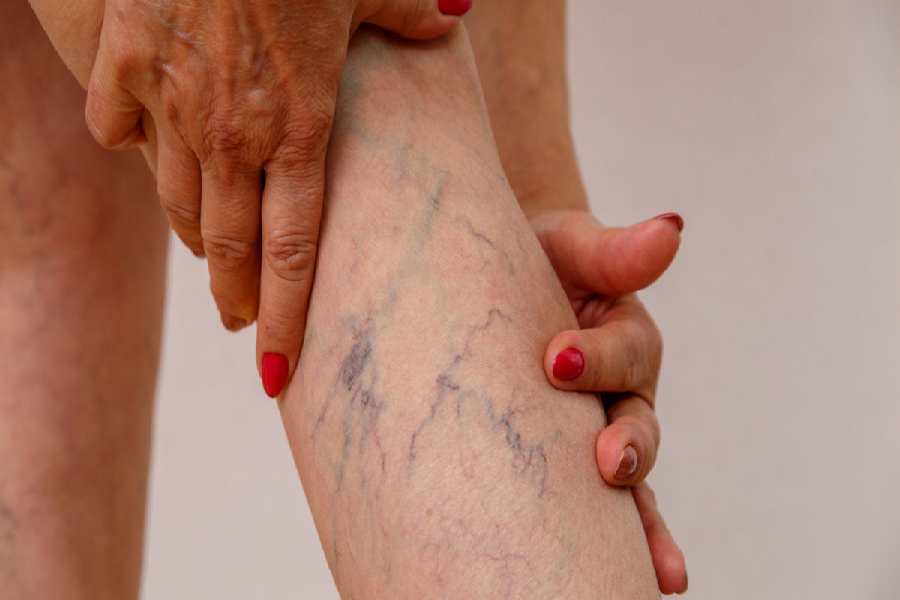 গরমে এর বাড়াবাড়ি হলেও শীতেও ভেরিকোজ ভেনসের সমস্যা দেখা যায়। 