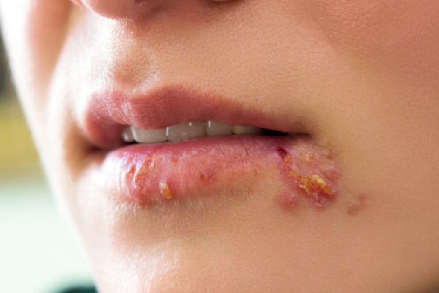 ভাল করে খাওয়াদাওয়া করলে ঠোঁটের কোণে এই ধরনের ঘা কম হয়। 