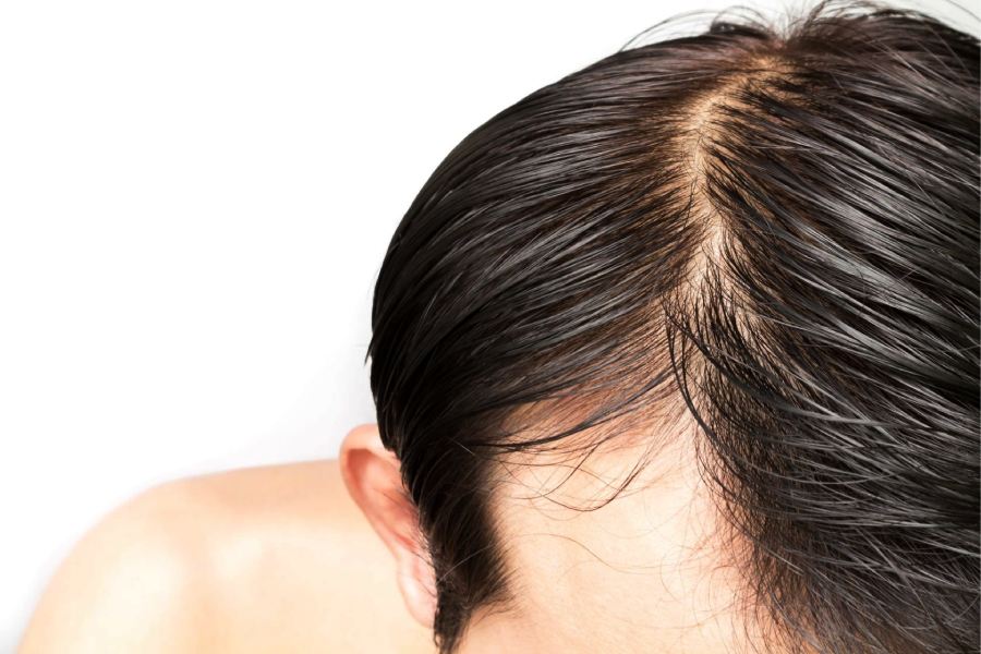 Image of Oily hair and Scalp 