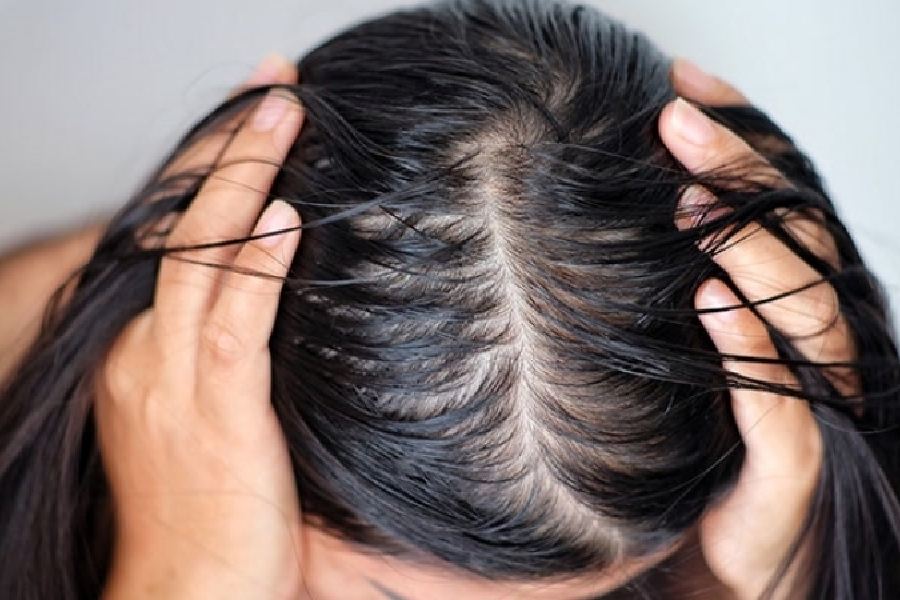 Image of Oily hair and Scalp