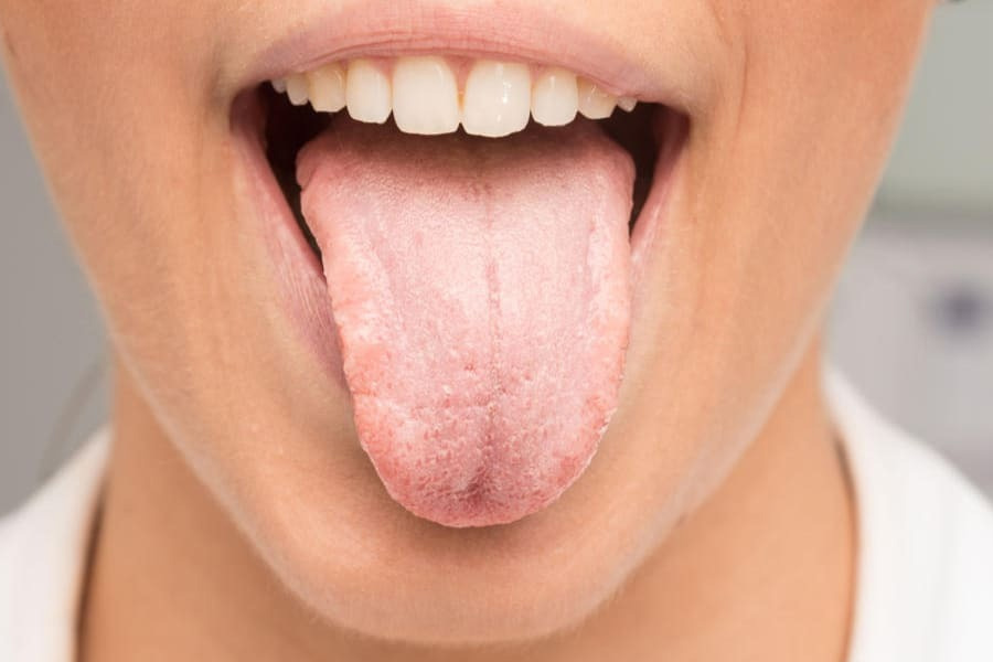 Colour of your tongue can reveal these diseases.