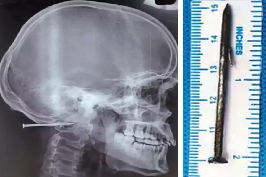 Man saved by critical operation after 2 inches long nail inserted in his head.