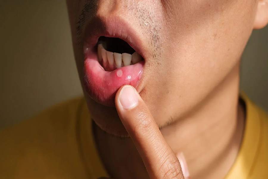 image of mouth Ulcer.