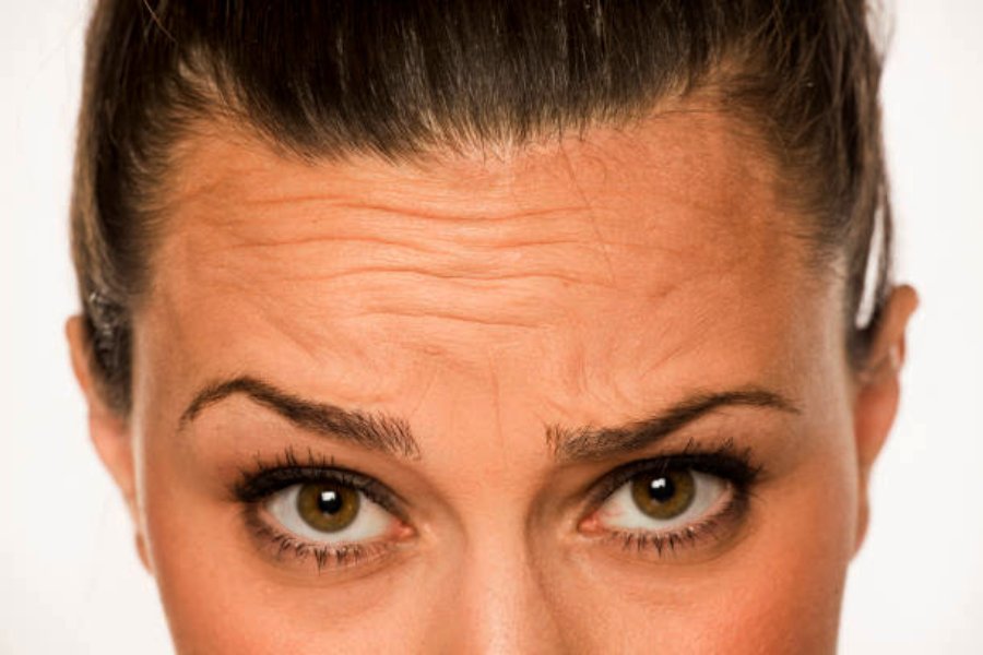 Image of forehead wrinkles