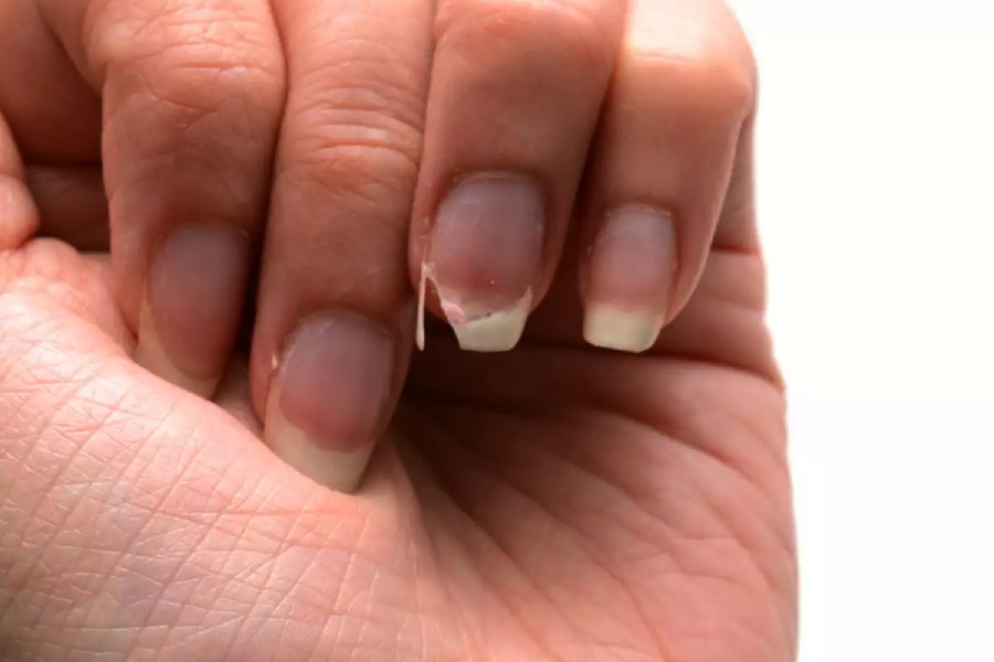 Image of Brittle Nails