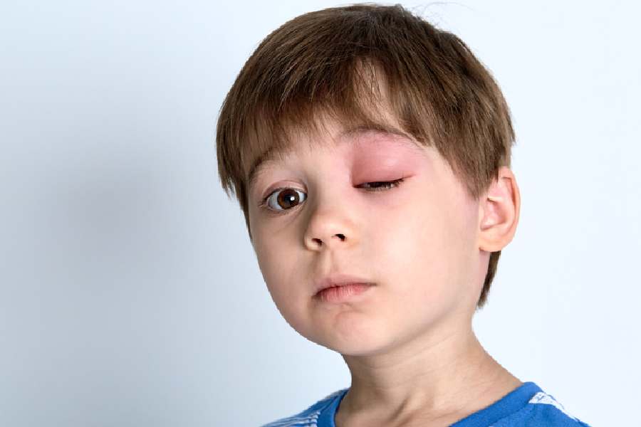 সুইমিং পুলের জল থেকেও ছড়াতে পারে চোখের সংক্রমণ।