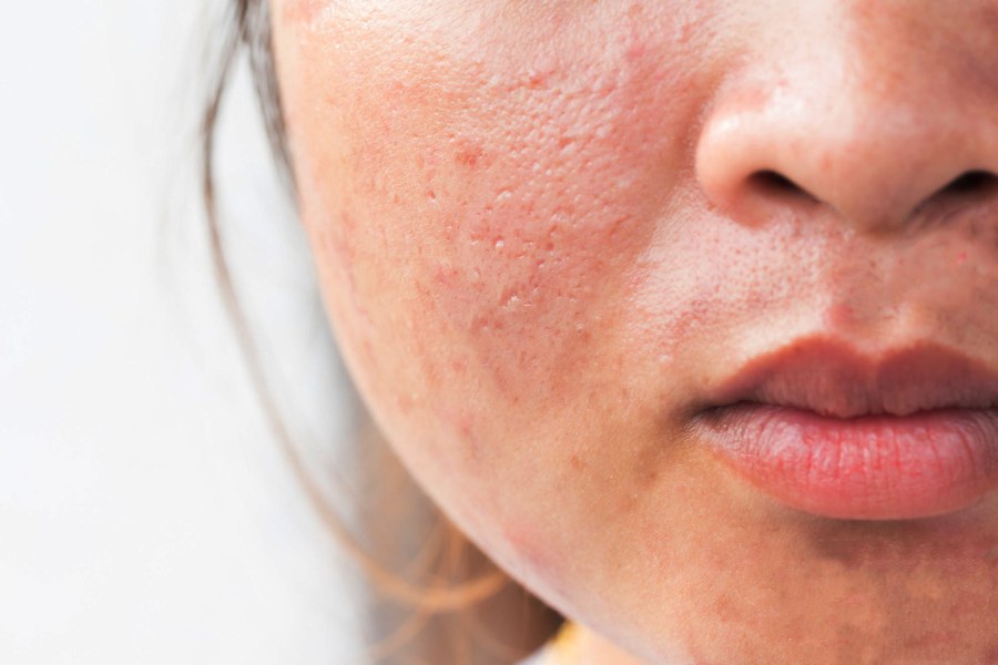 Image of Acne