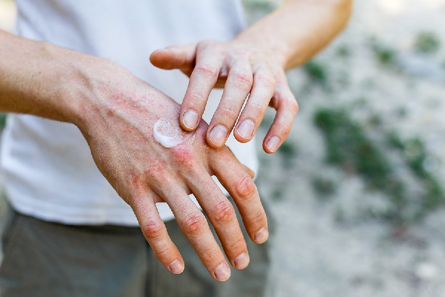 Image of dry hands 