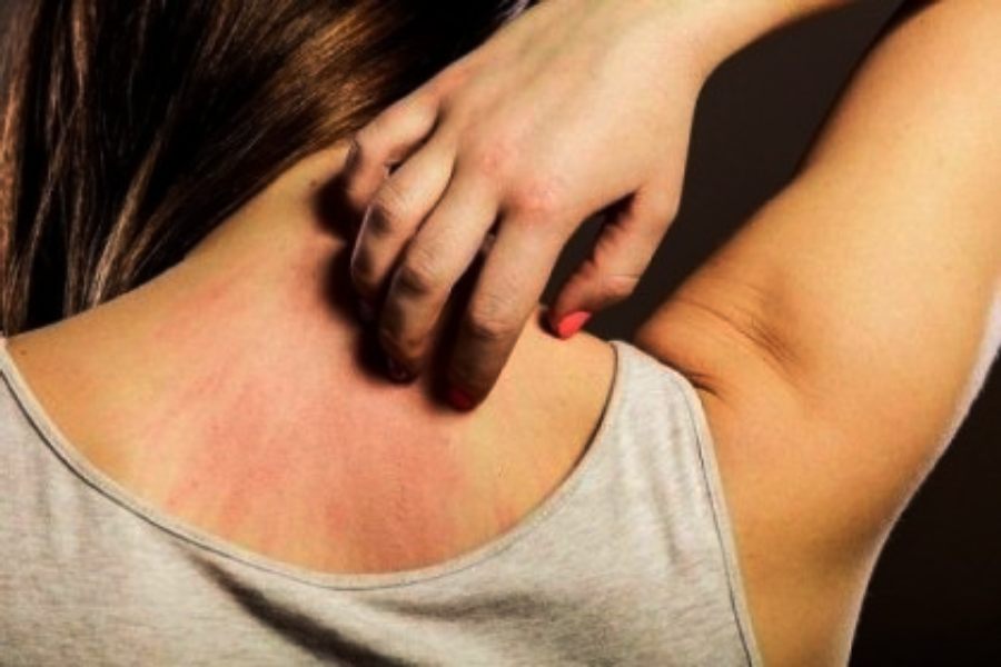 Image of Itching