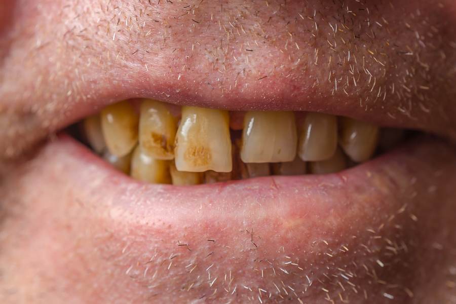 Image of smoking stain on teeth.