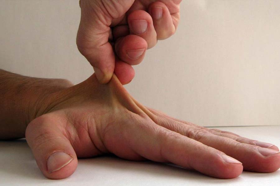 ব্রিটিশ সংবাদমাধ্যম ‘ডেলি মেল’-এর প্রতিবেদন অনুযায়ী, লিলির দেহে সমস্যার শুরু কিশোরী অবস্থায়। ১৭ বছর বয়সে ইলার্স ড্যানলোস সিনড্রোম (ইডিএস) উপসর্গ ধরা পড়েছিল তাঁর। তাতে ত্বক অতিরিক্ত নমনীয় হওয়া থেকে অস্থিসংযোগগুলি অতিরিক্ত মাত্রায় সক্রিয় হয়ে পড়ে। রক্তনালিতেও সমস্যা দেখা দেয়।