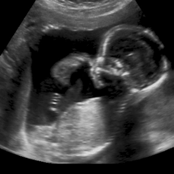 চিকিৎসাশাস্ত্রে এই ধরনের ঘটনাকে বলা হয় ‘ফিটাস ইন ফিটু’। যেখানে মা যমজ সন্তানের জন্ম দেন। কিন্তু এক সন্তানের ভিতরেই জন্ম নেয় আর এক জন।