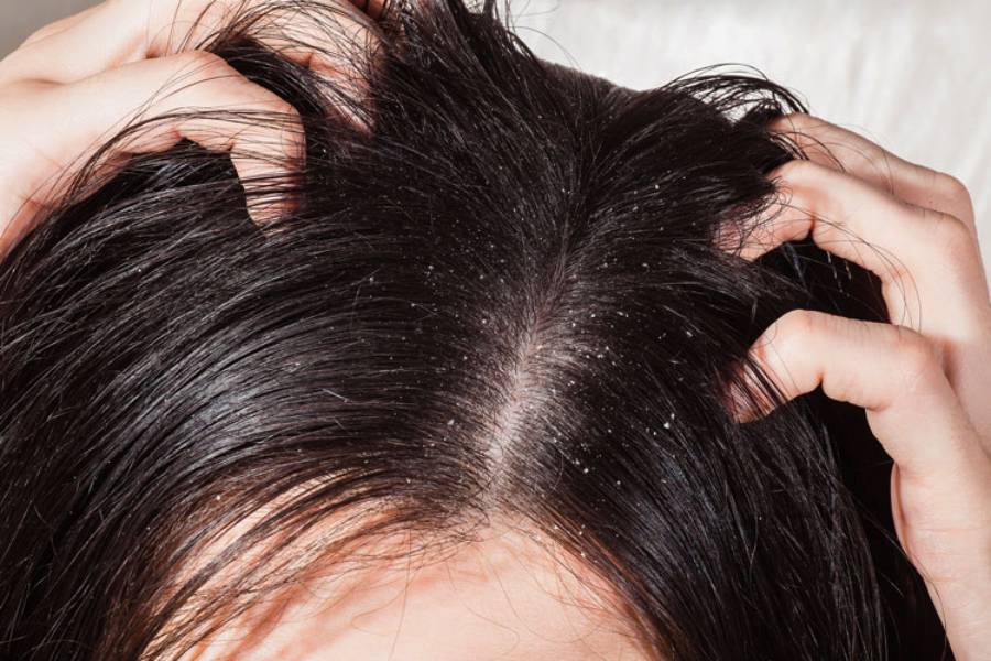 Image of Dandruff.