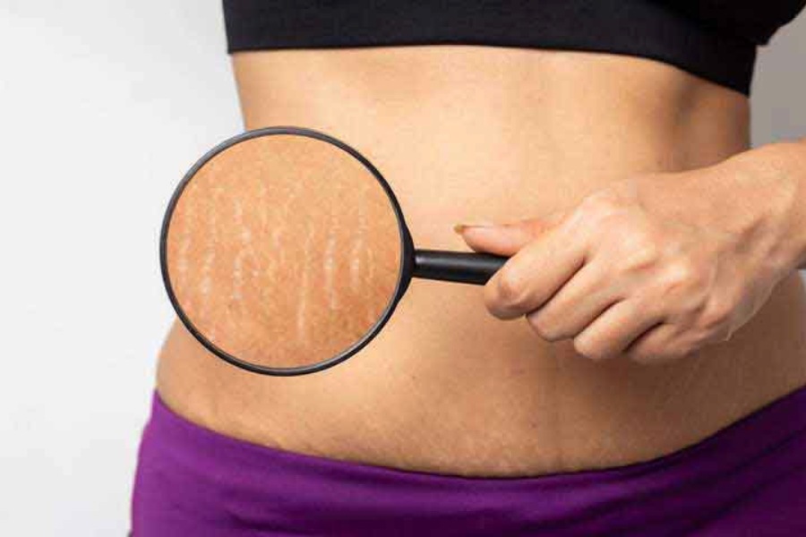 ওজন বেড়ে গেলেও কিন্তু কোমর, স্তন, উরু, পেটের আনাচ-কানাচে স্ট্রেচ মার্ক উঁকি মারে। 