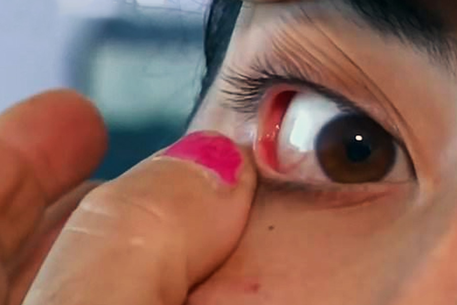 Armenian girl who alleges of crying crystals is suffering from rare disease.