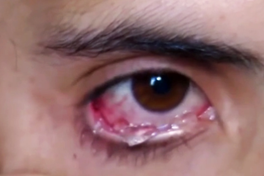 Armenian girl who alleges of crying crystals is suffering from rare disease.