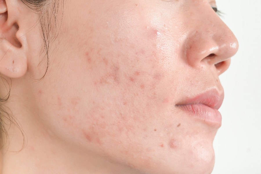 Symbolic Image of Acne