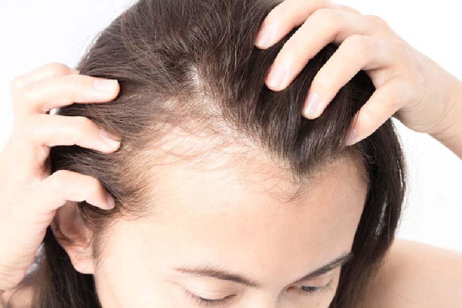 Symbolic Image of bald