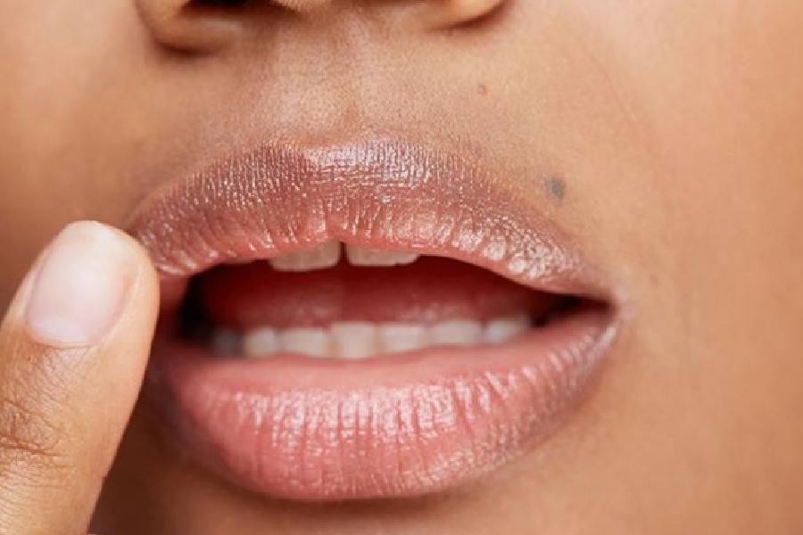 What causes black spots on your lips