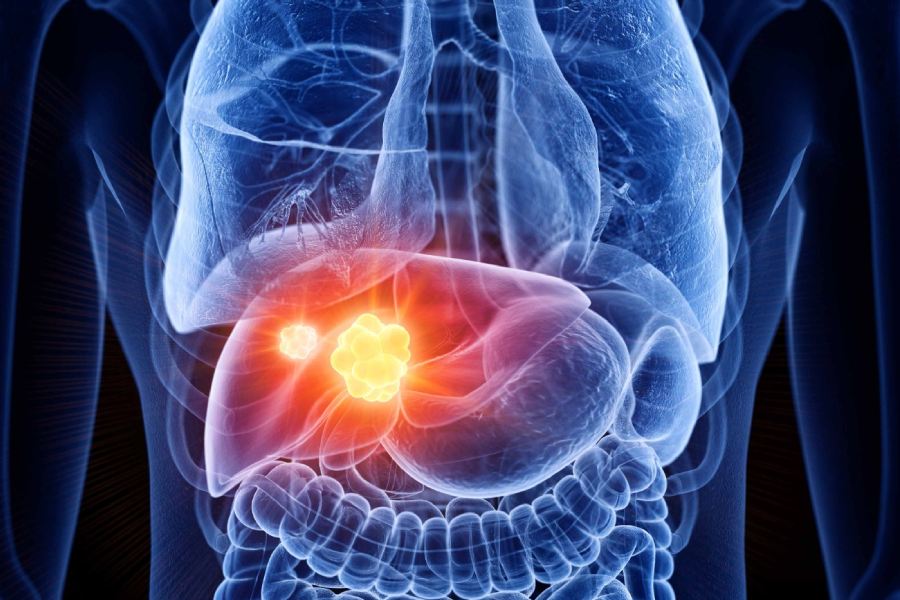Symbolic image of Fatty Liver 