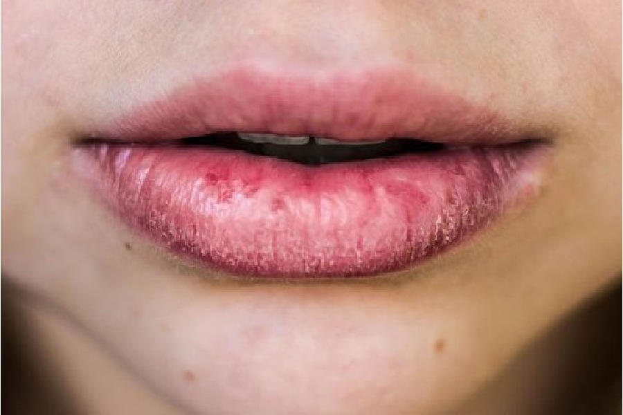 prevent and treat sunburned lips