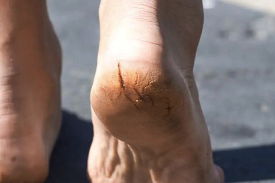 Image of cracked heel.