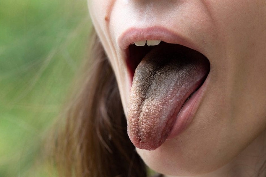 black hairy tongue condition