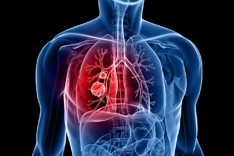 Image of Lung Cancer.