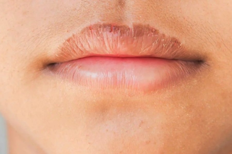 Image of Cracked Lips.