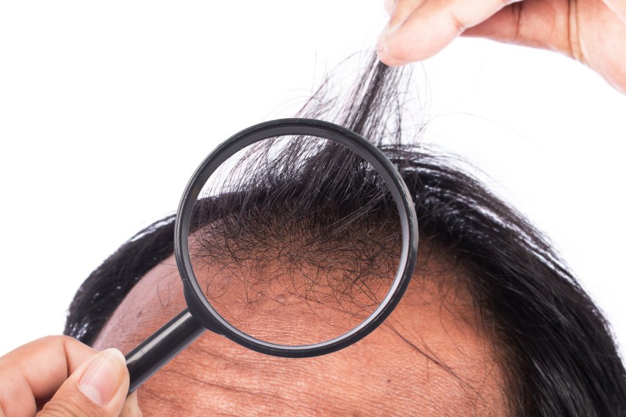 Image of hair density 