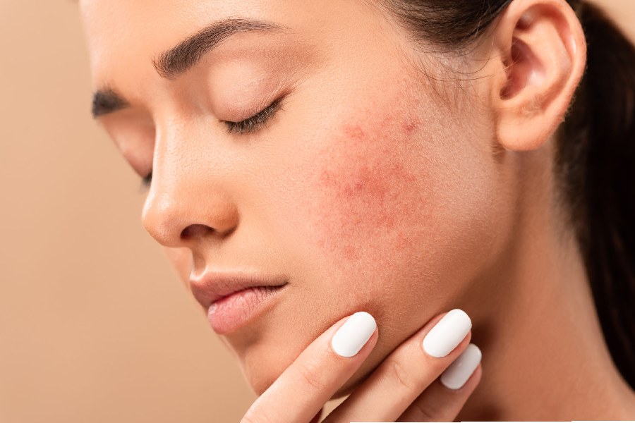 Image of Acne.
